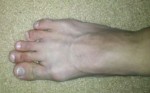 Deformed and elongated middle toes.